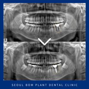 방이역임플란트9