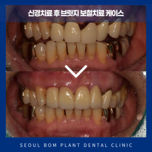서울봄플란트치과_브릿지보철치료-케이스증례-표지