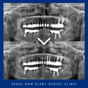 마천동치과 앞니 뿌리 끝 염증으로 임플란트
